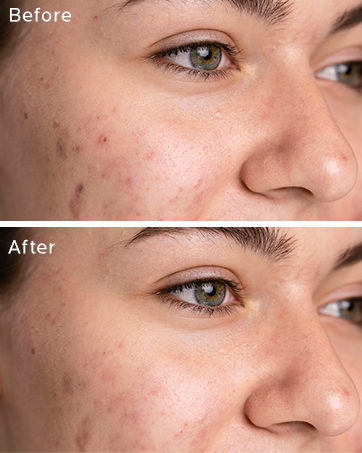 ZealSea 2% Salicylic Acid Toner for Face with 2% Niacinamide - BHA Liquid Exfoliant