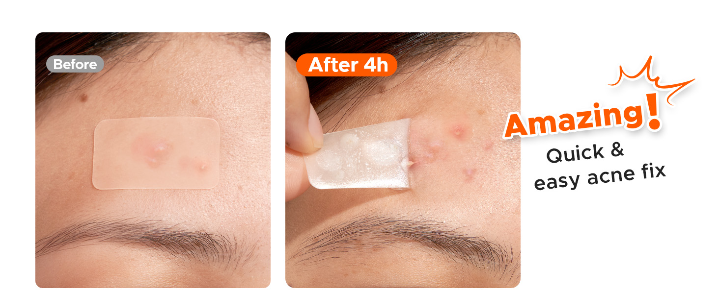 large pimple patches