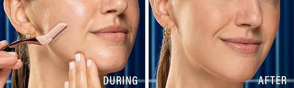 Dermaplaning