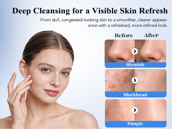 blackhead remover