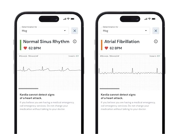Four mobile screens showing EKG detections.