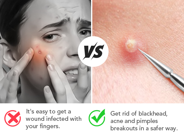 pimple popper tools