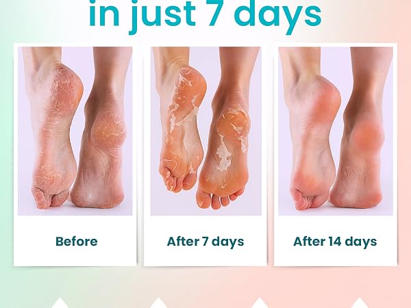 foot peel foot peel mask tca chemical peel foot mask peel foot peel mask for dry cracked feet extrem