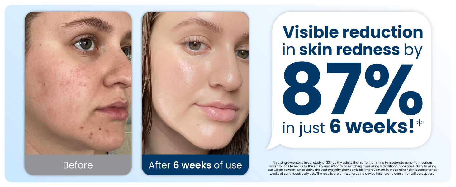 Visible reduction in skin redness by 87% in just 6 week