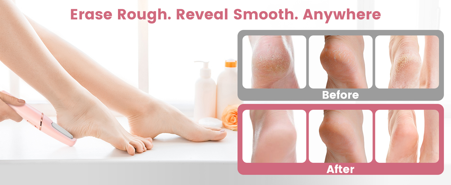 calus, remover for feet electric foot callus remover electric foot callus remover tool electric