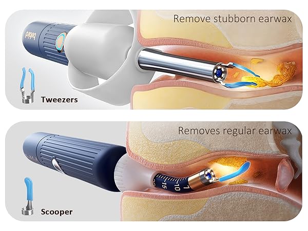 ear camera wax removal
