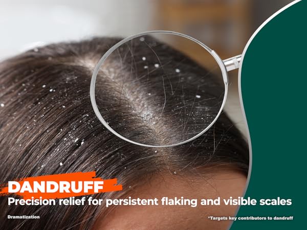 Dandruff shampoo for persistent flaking and visible scales, magnifying glass on scalp with flakes