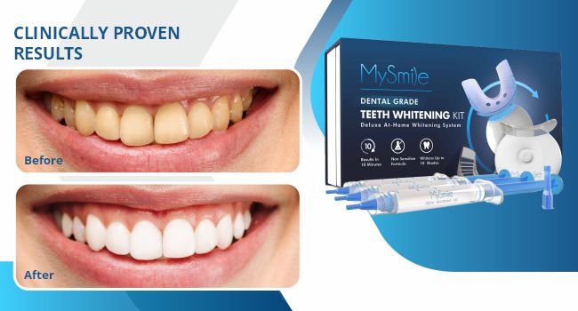 10 Min Fast teeth whitening kit