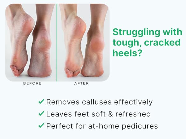 remover pedicure tool file dry callus foot beauty skin health care hard best surface wet remove
