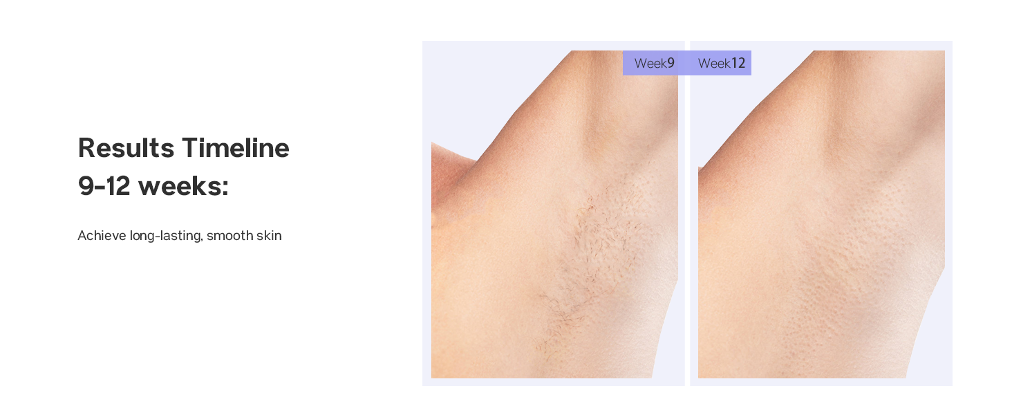 laser hair removal device