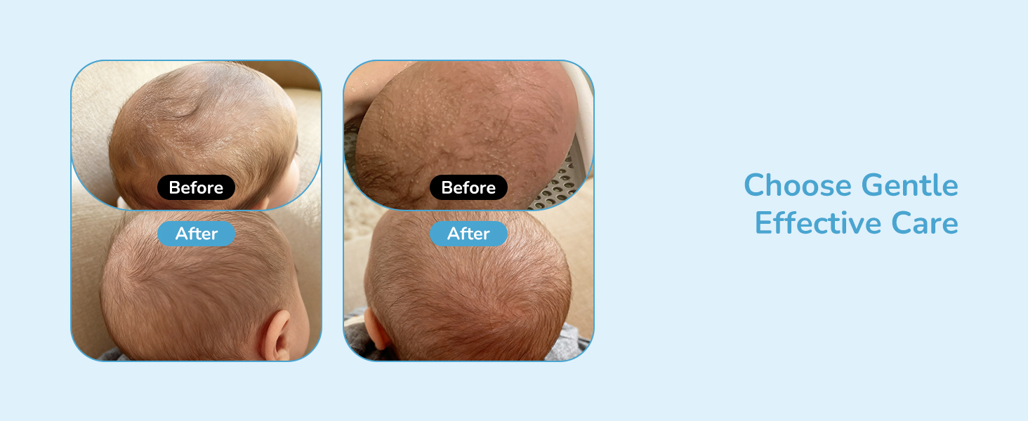 cradle cap treatment