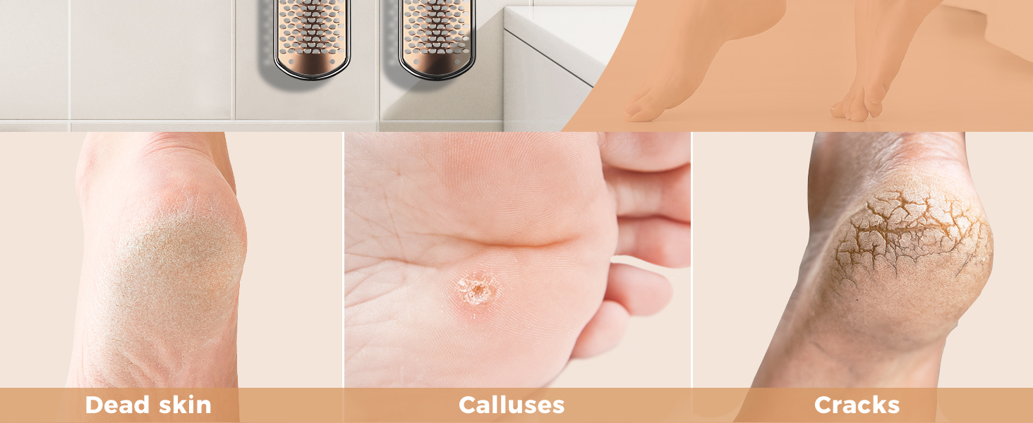 Four-panel image showing close-ups of foot skin conditions: dead skin, calluses, and cracks. Medical or beauty product demonstration context.