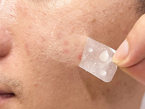 Hydrocolloid Patches