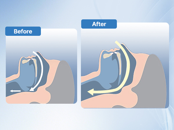 Anti Snoring Devices