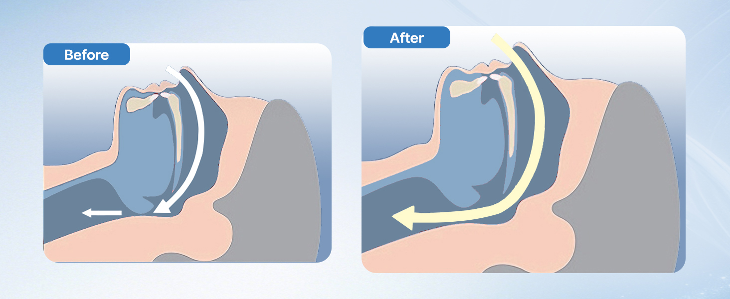 Anti Snoring Devices