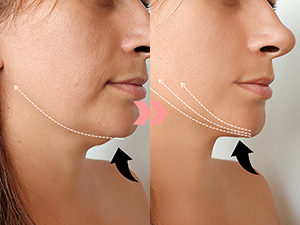 face contouring device