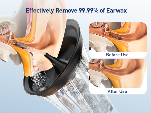 ear wax removal kit