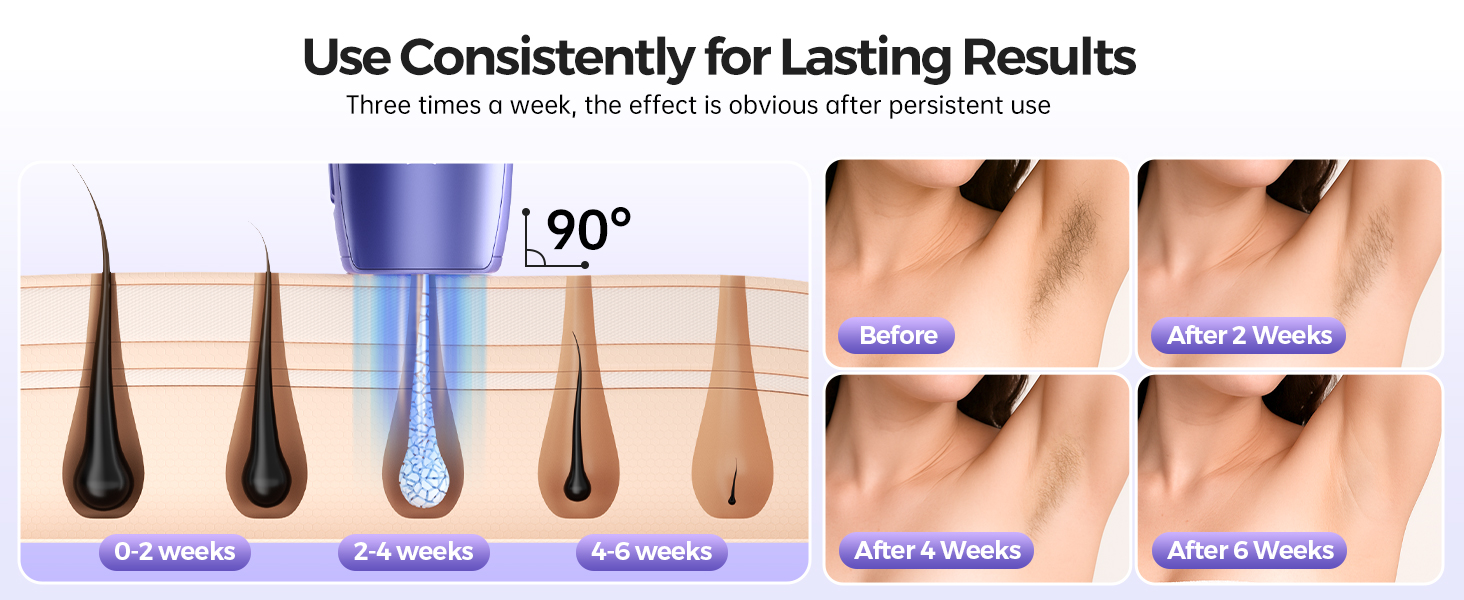 ipl laser hair removal