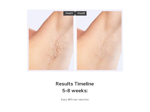 laser hair removal device