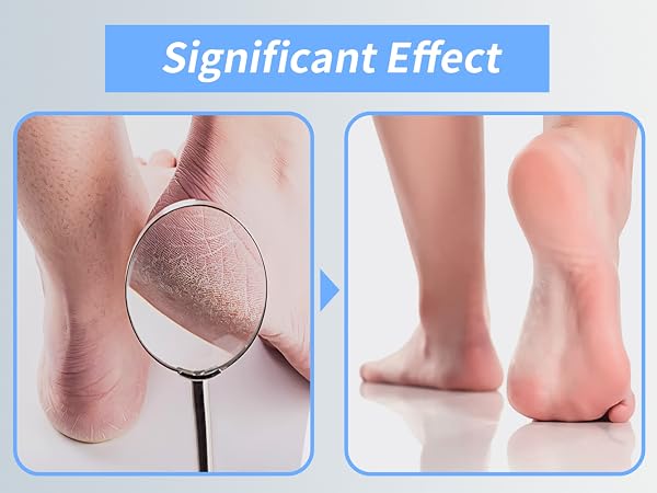 Foot File for Dead Skin