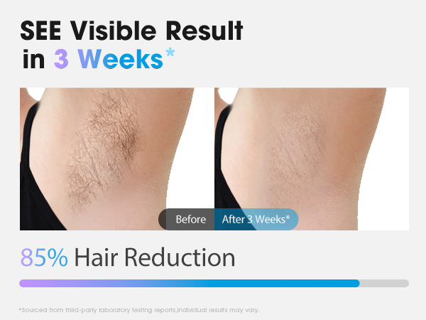 laser hair removal for women