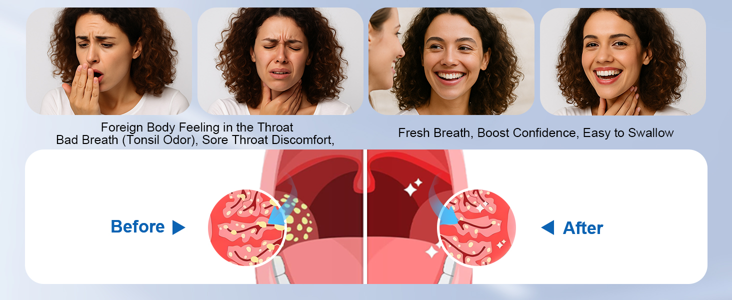 Tonsil Stone Remover