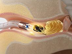 Multiple cleaning methods