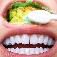 teeth whitening
