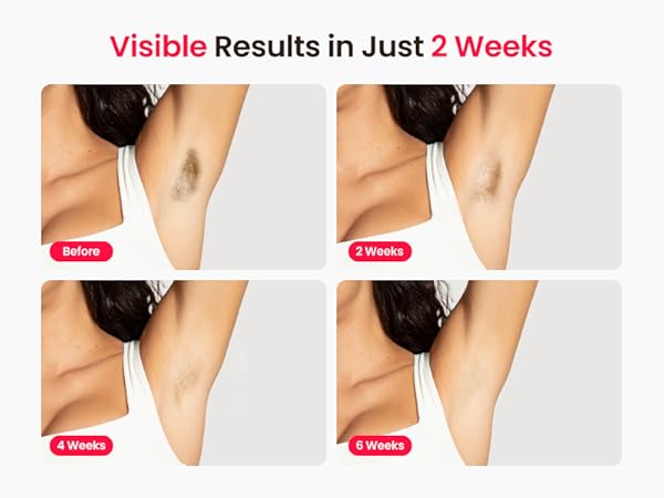 hair removal laser for women