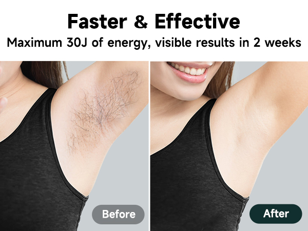 laser hair removal
