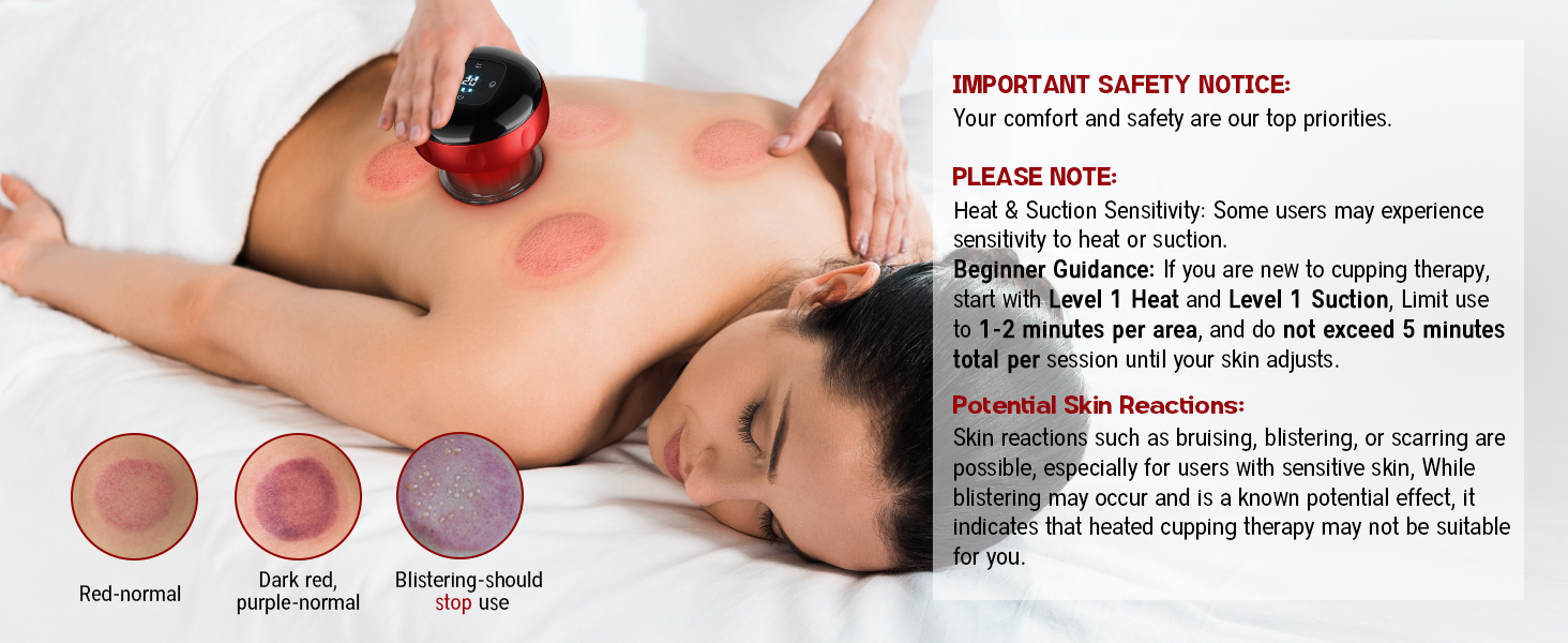 cupping