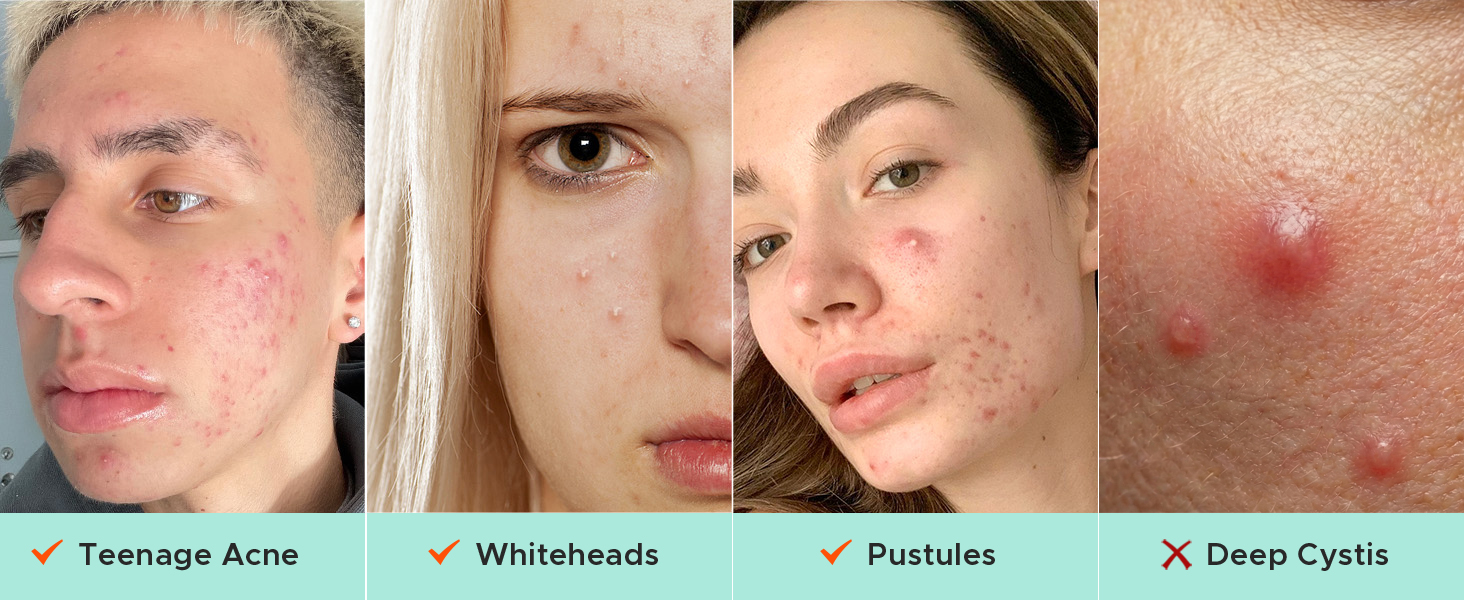 Suitable for Most Pimples