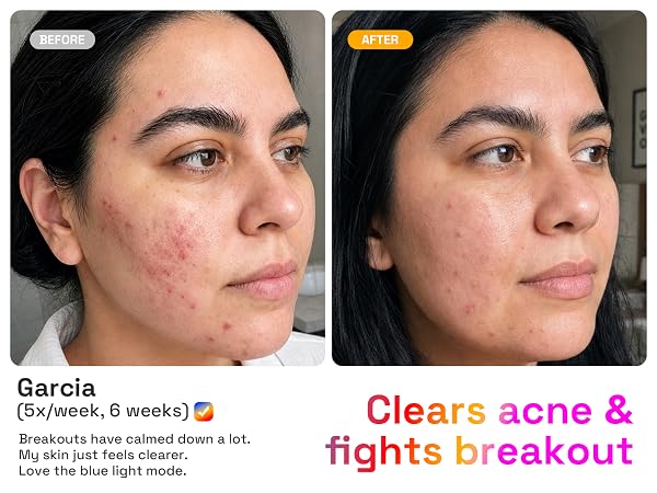 Clears acne