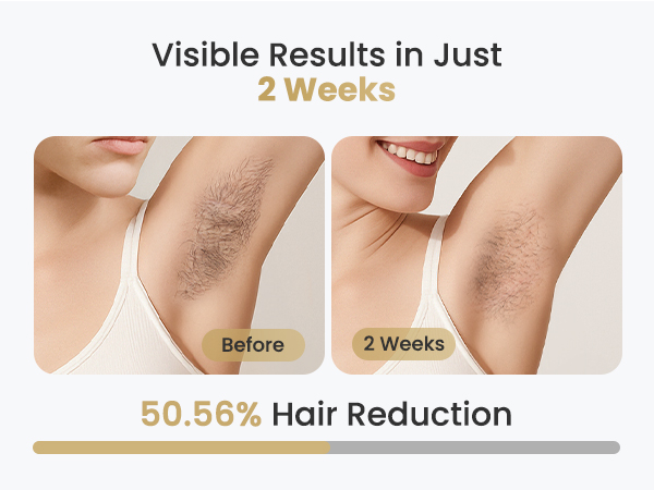 ipl laser hair removal
