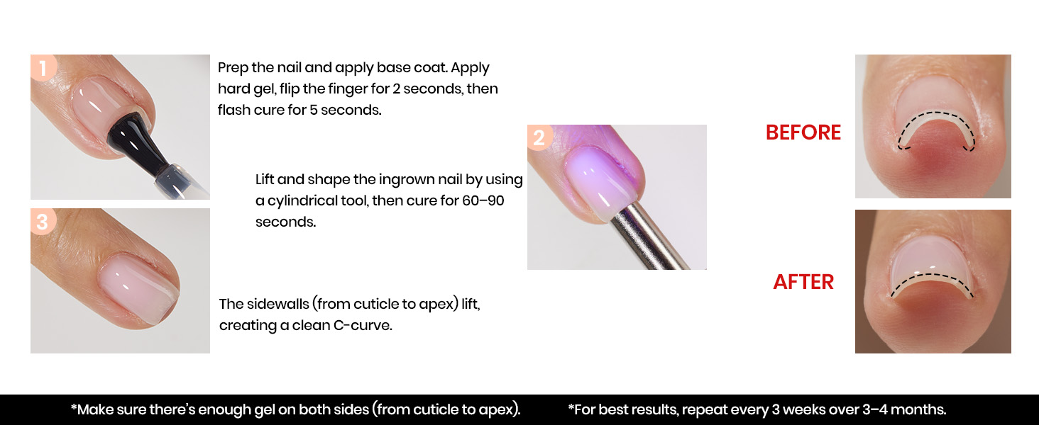 Correct Ingrown Nails