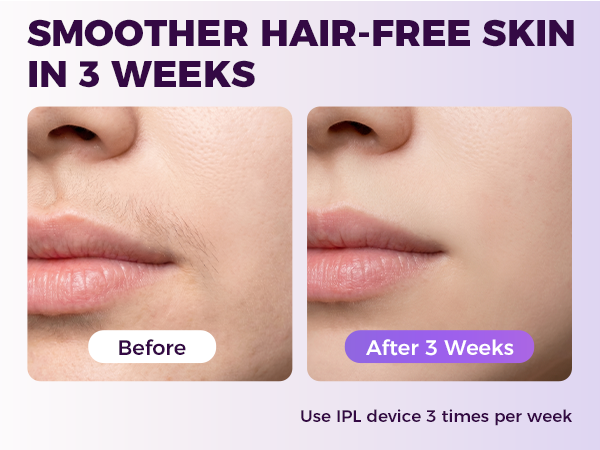 laser hair removal for women