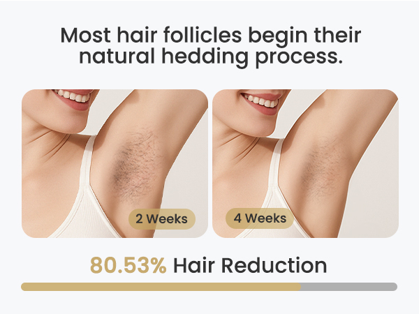 at home laser hair removal