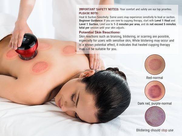 cupping
