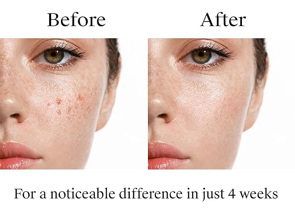 maximum strength 10% benzoyl peroxide acne prone skin care acne-fighting fsa has acne treatment