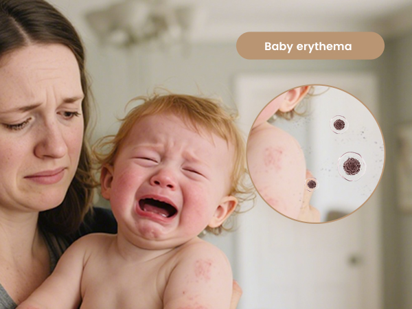 Baby erythema
