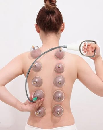 cupping