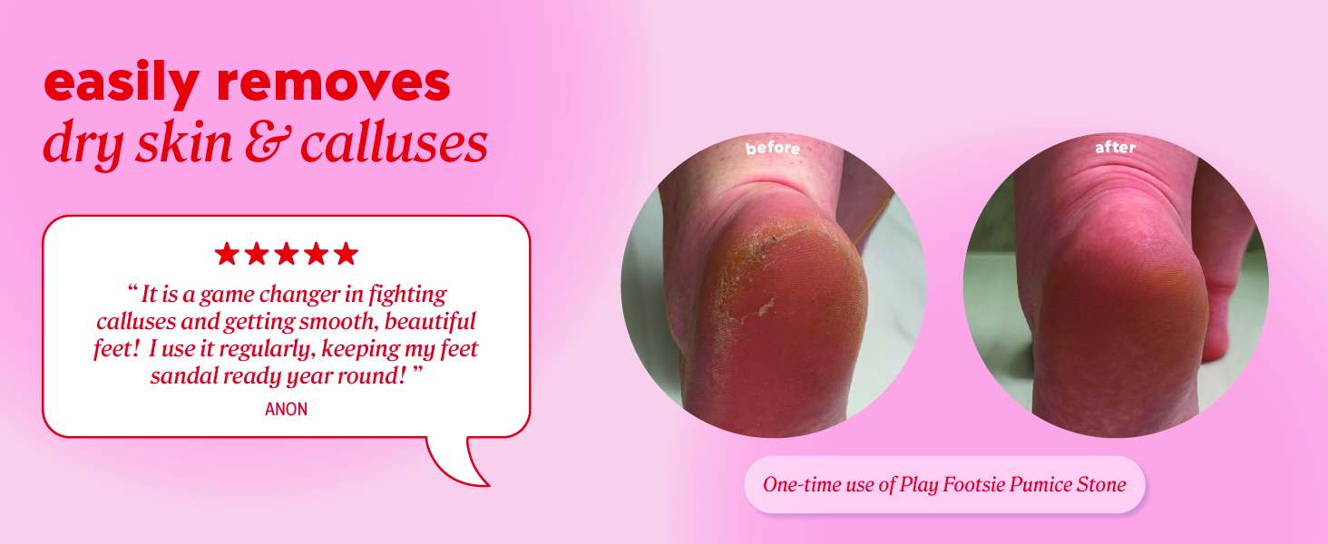 Customer review: It is a game changer in fighting calluses getting smooth beautiful feet.
