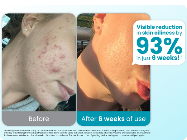 Visible reduction in skin oiliness by 93% in just 6 week