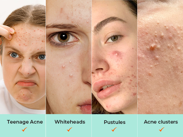 For Different Acne Types