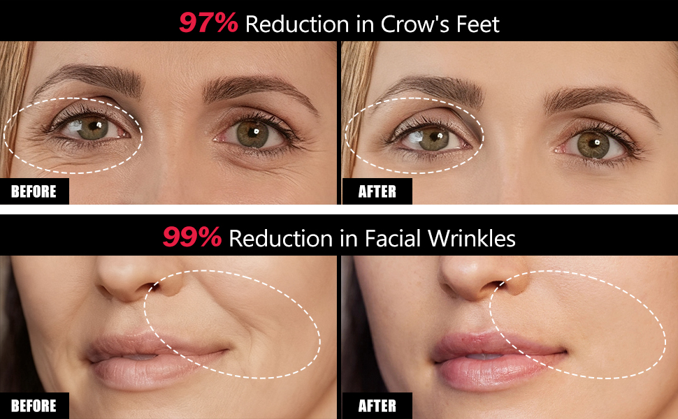 Microcurrent Facial Device