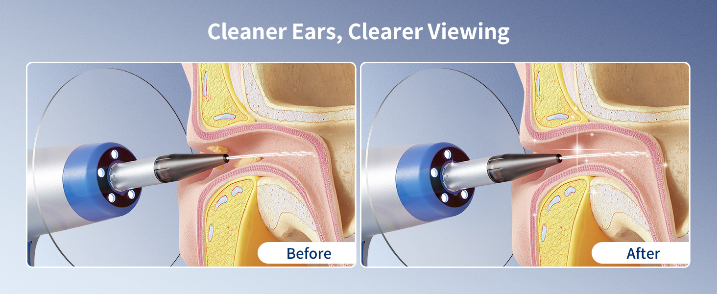 ear wax removal tool