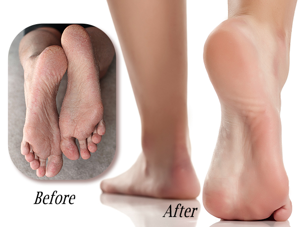 Smooth feet