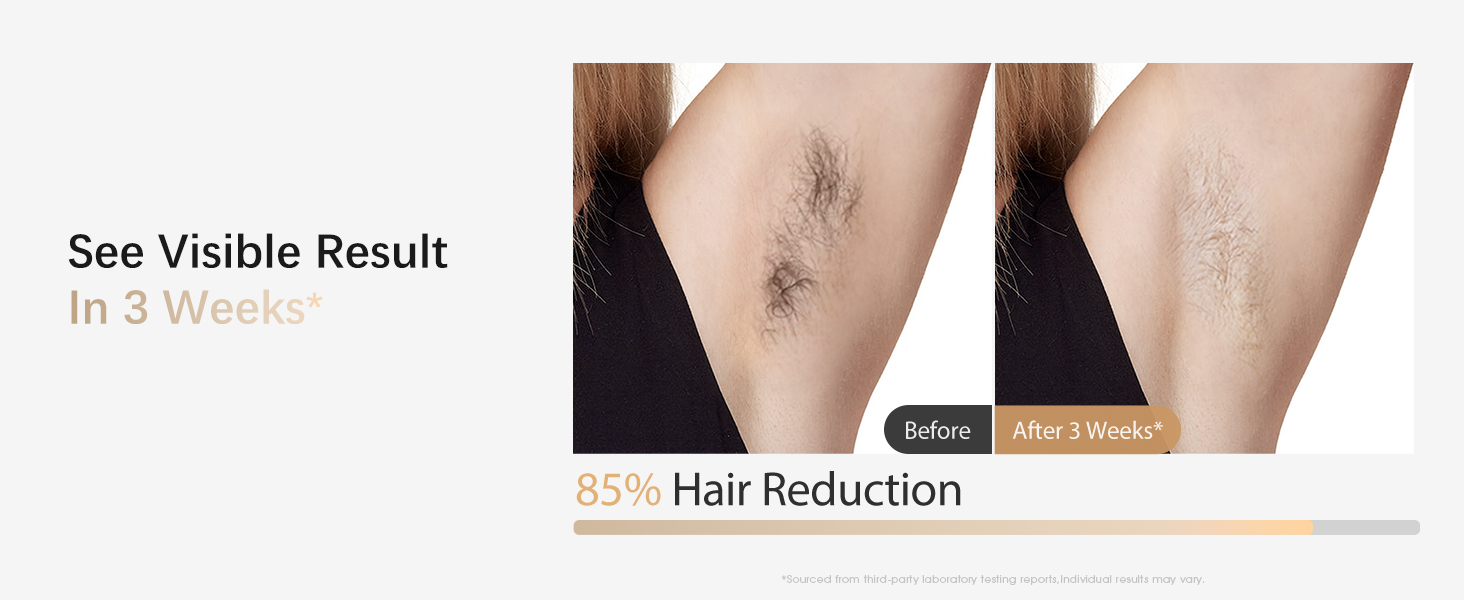 at home laser hair removal for women