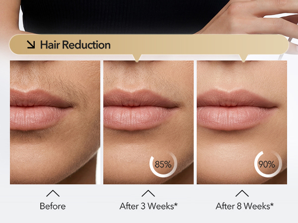 laser hair removal
