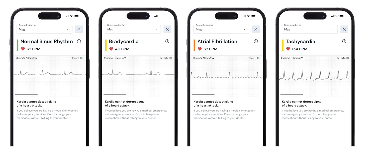 Phone screens showing EKG from Kardia heart monitor detecting afib, bradycardia, tachycardia